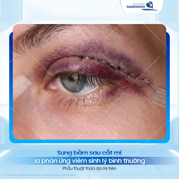 Cắt Mí Mắt Bị Sưng Bầm Bao Lâu Hết? Cách Giảm Sưng Nhanh