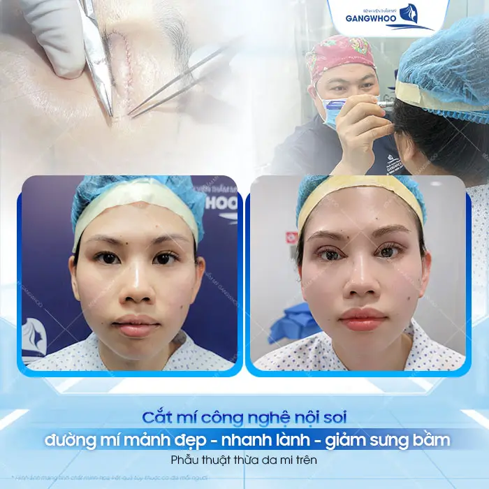 Cắt Mí Mắt Bị Sưng Bầm Bao Lâu Hết? Cách Giảm Sưng Nhanh