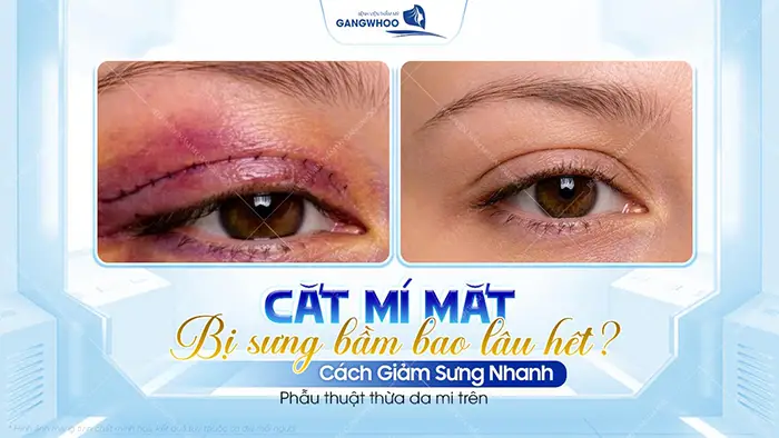 cat mi mat bi sung bam bao lau het