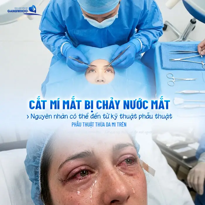 Cắt Mí Mắt Xong Bị Chảy Nước Mắt: Nguyên Nhân Và Cách Xử Lý