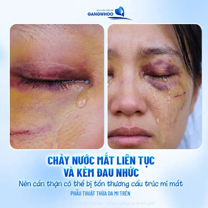 Cắt Mí Mắt Xong Bị Chảy Nước Mắt: Nguyên Nhân Và Cách Xử Lý