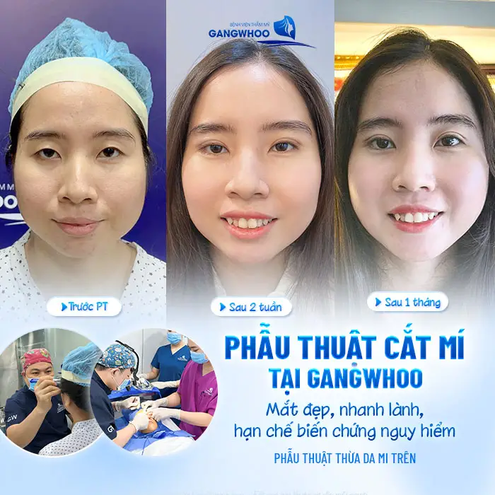 Cắt Mí Mắt Xong Bị Chảy Nước Mắt: Nguyên Nhân Và Cách Xử Lý