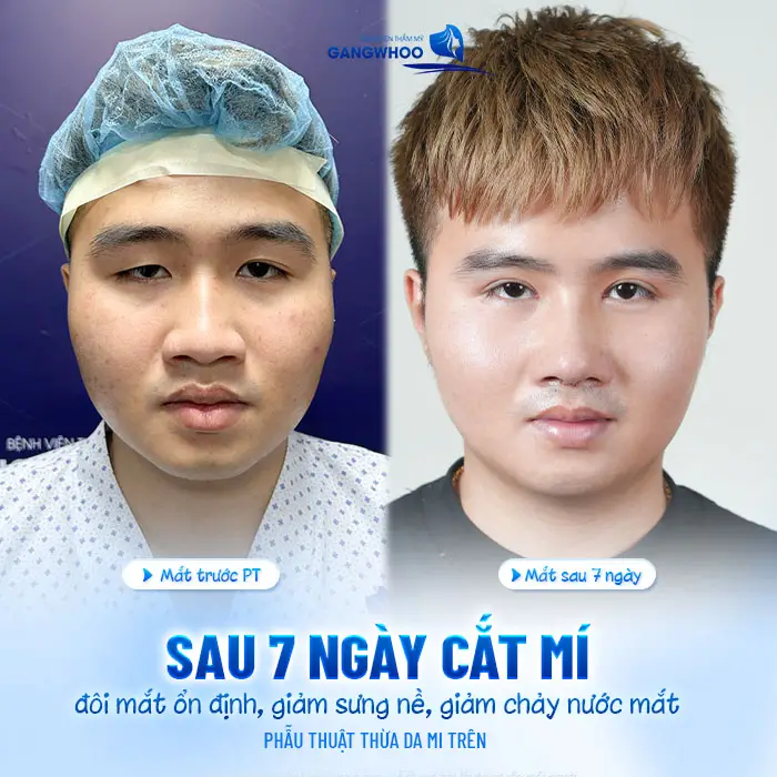 Cắt Mí Mắt Xong Bị Chảy Nước Mắt: Nguyên Nhân Và Cách Xử Lý