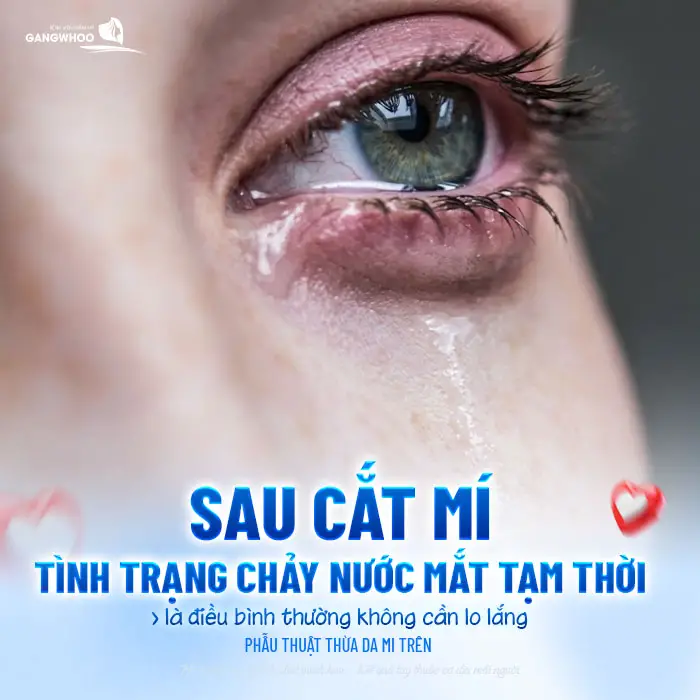 Cắt Mí Mắt Xong Bị Chảy Nước Mắt: Nguyên Nhân Và Cách Xử Lý