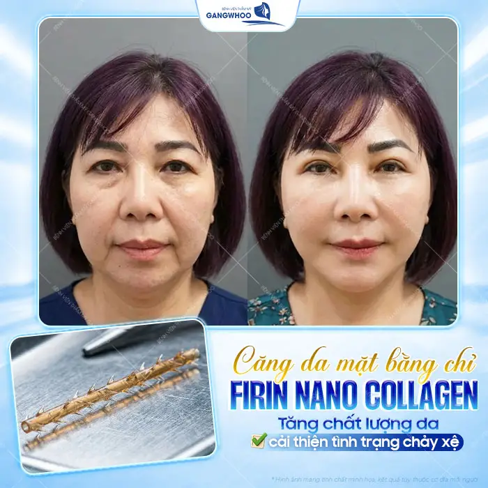 8 Loại Chỉ Căng Da Mặt Phổ Biến Bác Sĩ Khuyên Dùng Hiện Nay