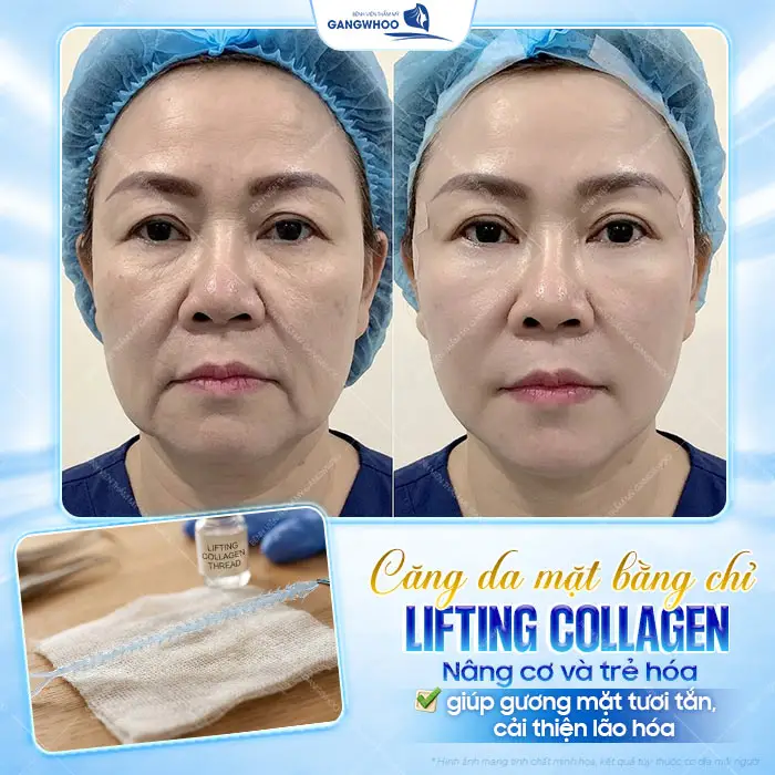 8 Loại Chỉ Căng Da Mặt Phổ Biến Bác Sĩ Khuyên Dùng Hiện Nay