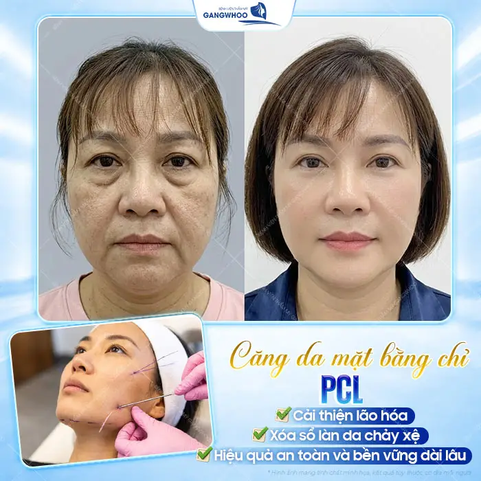 8 Loại Chỉ Căng Da Mặt Phổ Biến Bác Sĩ Khuyên Dùng Hiện Nay