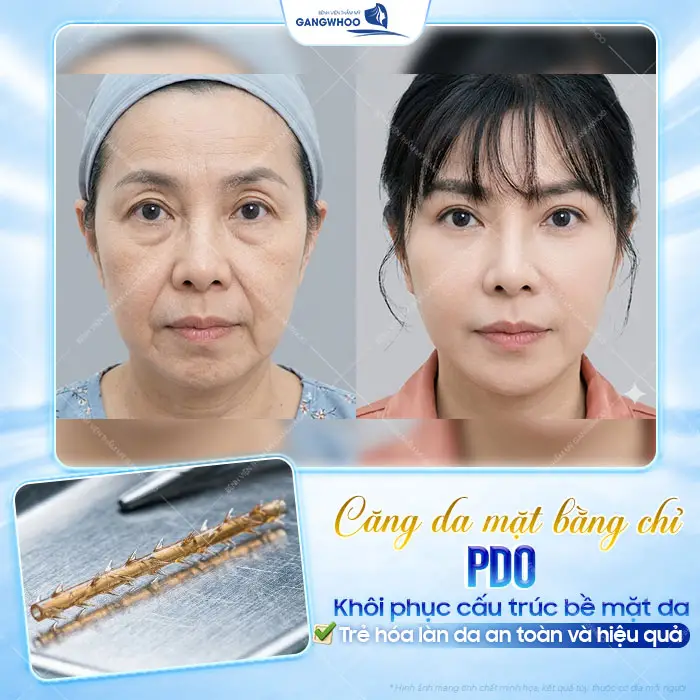 8 Loại Chỉ Căng Da Mặt Phổ Biến Bác Sĩ Khuyên Dùng Hiện Nay