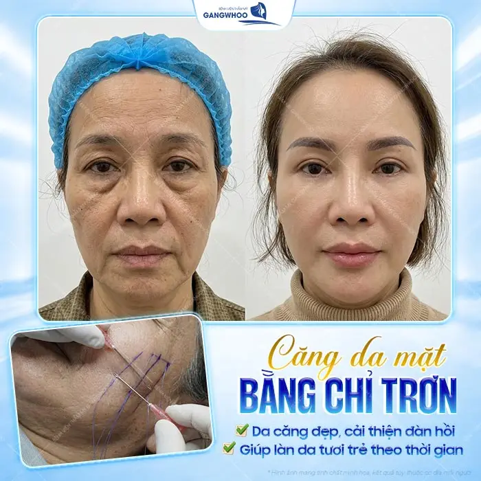 8 Loại Chỉ Căng Da Mặt Phổ Biến Bác Sĩ Khuyên Dùng Hiện Nay