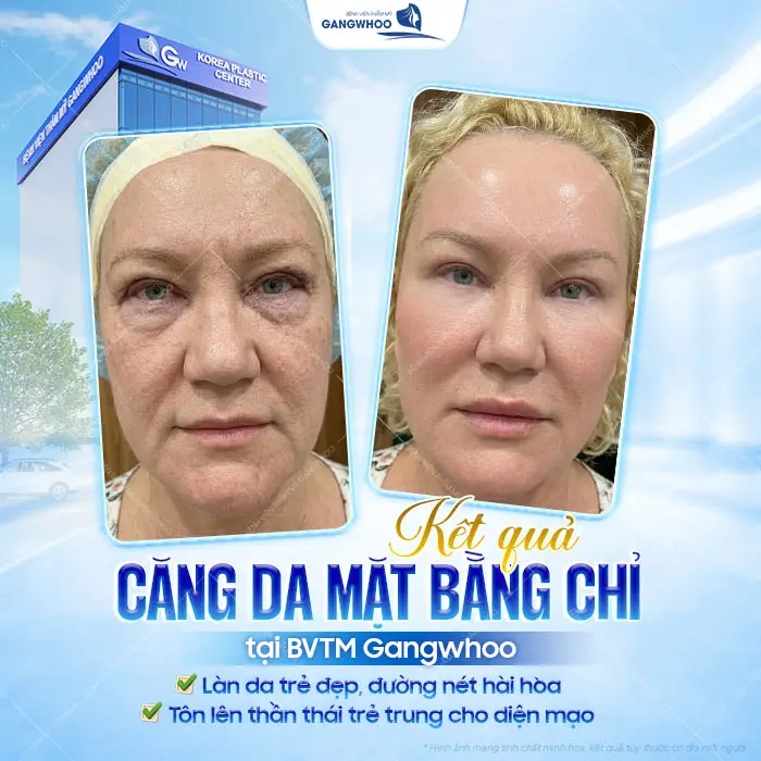 8 Loại Chỉ Căng Da Mặt Phổ Biến Bác Sĩ Khuyên Dùng Hiện Nay