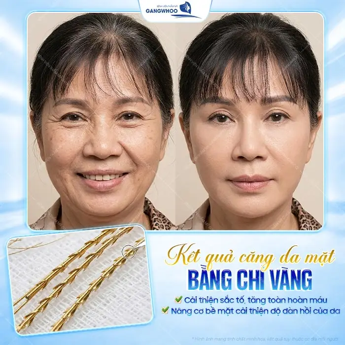 8 Loại Chỉ Căng Da Mặt Phổ Biến Bác Sĩ Khuyên Dùng Hiện Nay