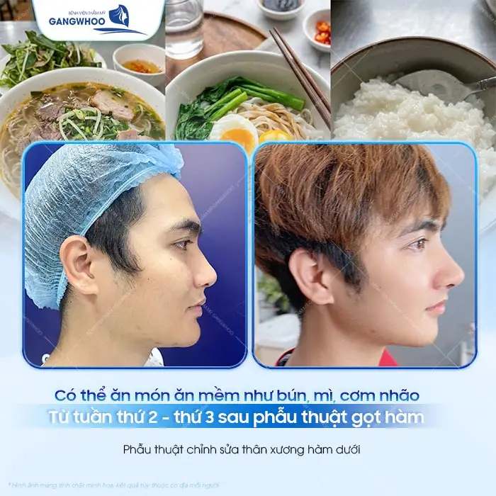 Đau Khi Ăn Nhai Sau Gọt Hàm Bao Lâu Hết? Bác Sĩ Giải Đáp