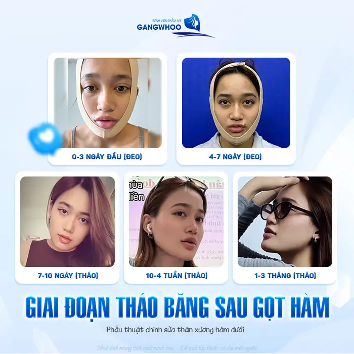 Gọt Hàm Bao Lâu Thì Tháo Băng? Hướng Dẫn Chăm Sóc