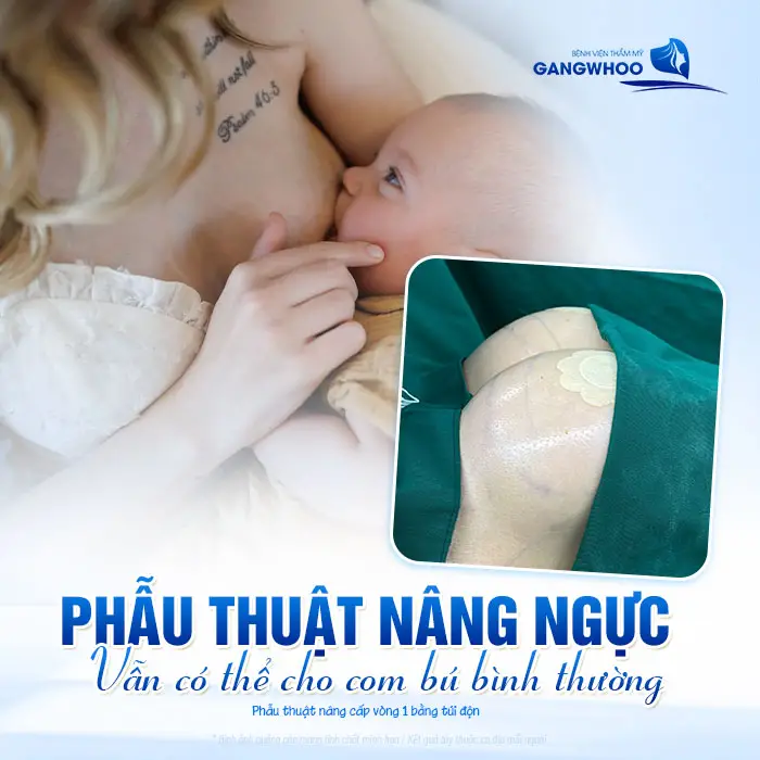 Nâng Ngực Xong Cho Con Bú Có Bị Xệ Không? Bác Sĩ Giải Đáp