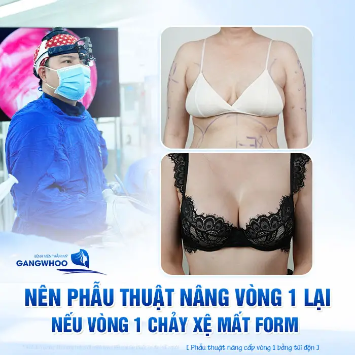 Nâng Ngực Xong Cho Con Bú Có Bị Xệ Không? Bác Sĩ Giải Đáp