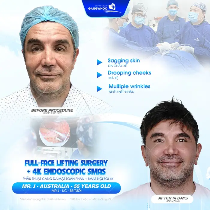 Phẫu thuật căng da mặt toàn phần Smas nội soi 4K khách hàng quốc tế đến từ Úc hài lòng về sự lột xác hoàn toàn thay đổi