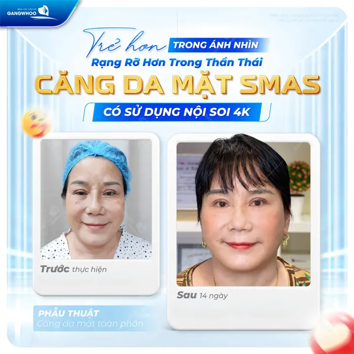 Top 8 Bác Sĩ Căng Da Mặt Nổi Tiếng Tay Nghề Cao Ở TPHCM 3 Trẻ hóa diện mạo với phiên bản rạng rỡ hơn sau căng da mặt Smas nội soi 4K có sử dụng nội soi 4K