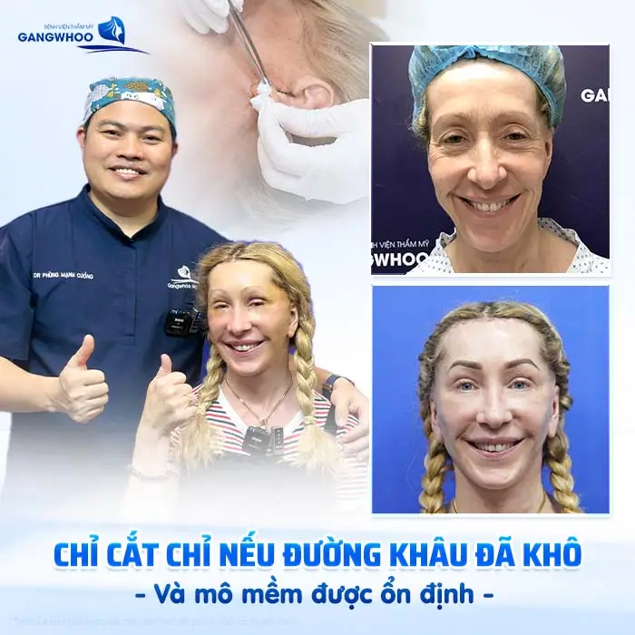 Chăm Sóc Sau Căng Da Mặt Phẫu Thuật Đúng Cách – Bí Quyết Giữ Gương Mặt Trẻ Lâu