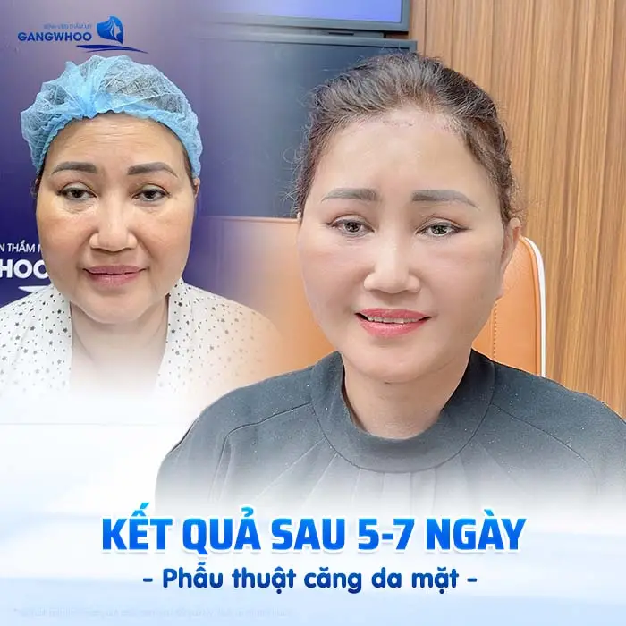 Căng Da Mặt Bao Lâu Cắt Chỉ? Thời Gian Hồi Phục Chi Tiết Từ Bác Sĩ