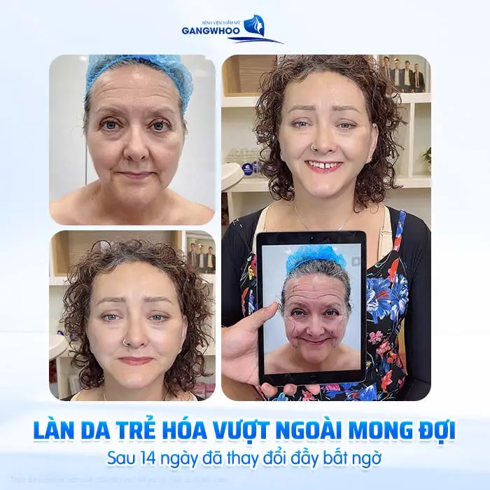 Căng Da Mặt Bao Lâu Cắt Chỉ? Thời Gian Hồi Phục Chi Tiết Từ Bác Sĩ