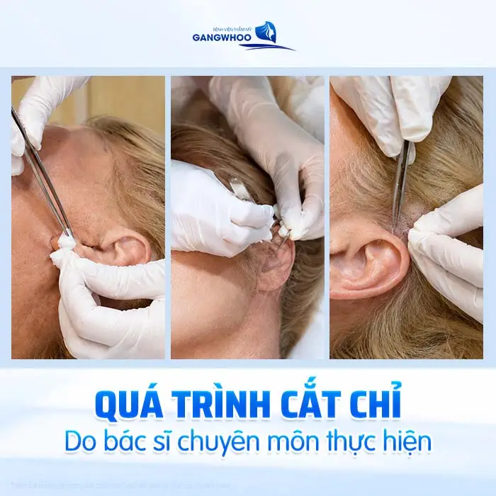Chăm Sóc Sau Căng Da Mặt Phẫu Thuật Đúng Cách – Bí Quyết Giữ Gương Mặt Trẻ Lâu