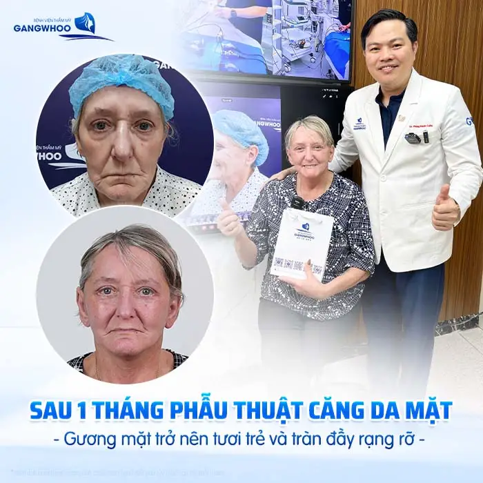 Căng Da Mặt Bao Lâu Cắt Chỉ? Thời Gian Hồi Phục Chi Tiết Từ Bác Sĩ