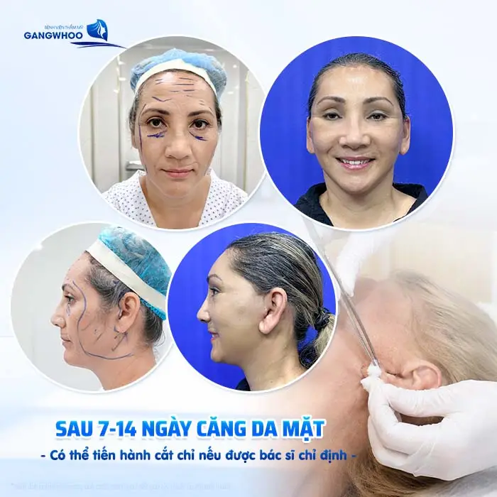 Căng Da Mặt Bao Lâu Cắt Chỉ? Thời Gian Hồi Phục Chi Tiết Từ Bác Sĩ