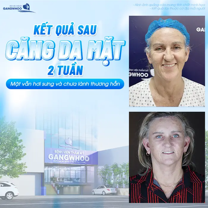 Sau Căng Da Mặt Bao Lâu Được Làm Liệu Trình Da? Bác Sĩ Giải Đáp