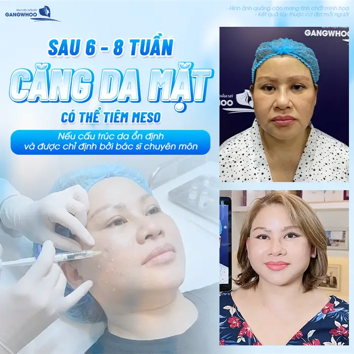 Sau Căng Da Mặt Bao Lâu Được Làm Liệu Trình Da? Bác Sĩ Giải Đáp