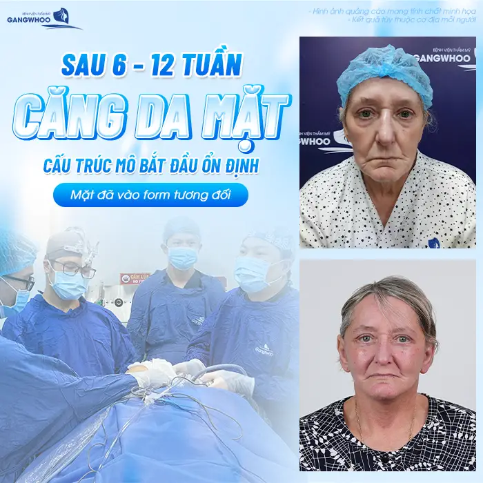 Sau Căng Da Mặt Bao Lâu Được Làm Liệu Trình Da? Bác Sĩ Giải Đáp