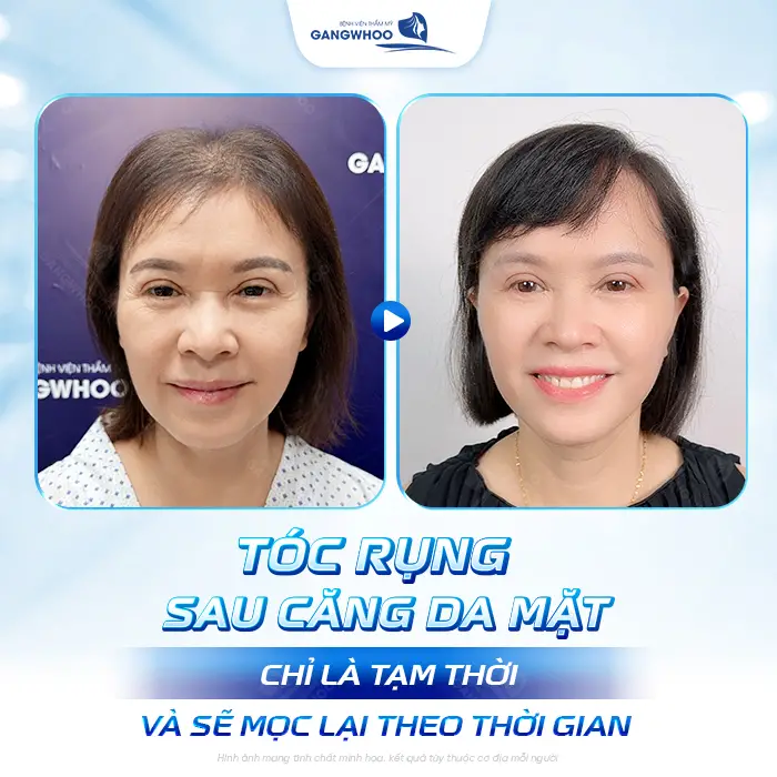 Căng Da Mặt Tóc Bao Lâu Mọc Lại? Bác Sĩ Thẩm Mỹ Giải Đáp