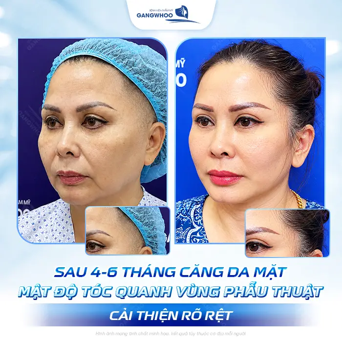 Căng Da Mặt Tóc Bao Lâu Mọc Lại? Bác Sĩ Thẩm Mỹ Giải Đáp