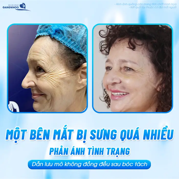 Tại Sao Căng Da Mặt Bị Bầm Mắt? Nguyên Nhân Và Cách Giảm Bầm