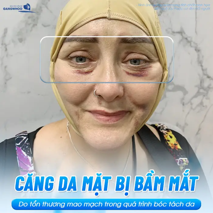Tại Sao Căng Da Mặt Bị Bầm Mắt? Nguyên Nhân Và Cách Giảm Bầm
