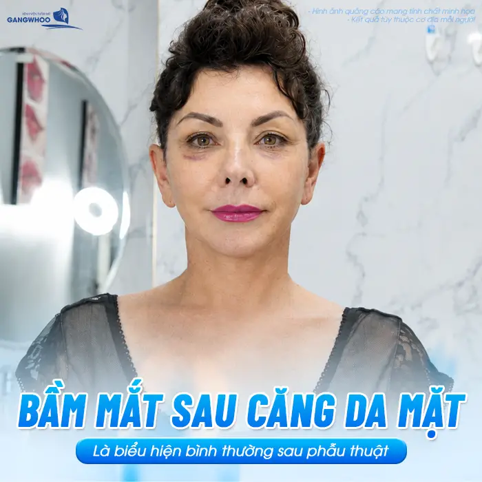 Tại Sao Căng Da Mặt Bị Bầm Mắt? Nguyên Nhân Và Cách Giảm Bầm