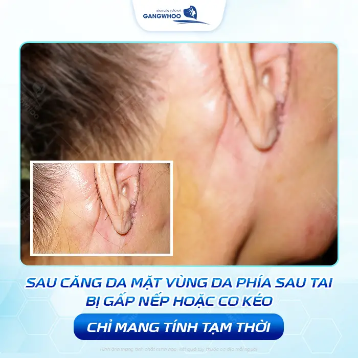 Căng Da Mặt Bị Nhăn Da Sau Tai Có Nguy Hiểm Không? Bác Sĩ Giải Đáp