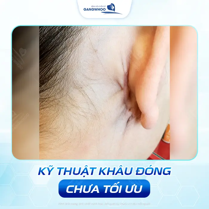 Căng Da Mặt Bị Nhăn Da Sau Tai Có Nguy Hiểm Không? Bác Sĩ Giải Đáp