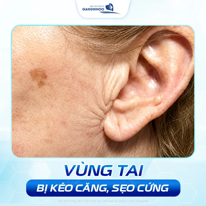 Căng Da Mặt Bị Nhăn Da Sau Tai Có Nguy Hiểm Không? Bác Sĩ Giải Đáp