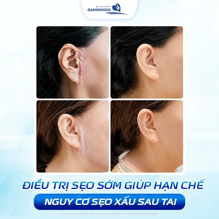 Căng Da Mặt Bị Nhăn Da Sau Tai Có Nguy Hiểm Không? Bác Sĩ Giải Đáp