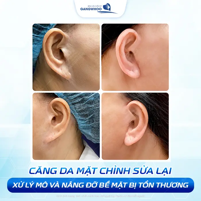 Căng Da Mặt Bị Nhăn Da Sau Tai Có Nguy Hiểm Không? Bác Sĩ Giải Đáp