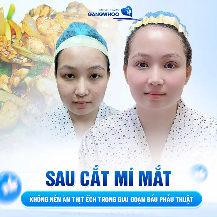 Sau cắt mí mắt không nên ăn thịt ếch trong giai đoạn đầu phẫu thuật 