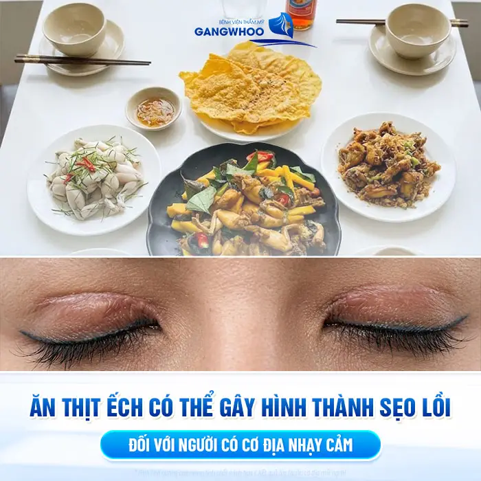 Ăn thịt ếch có thể gây hình thành sẹo lồi đối với người có cơ địa nhạy cảm 