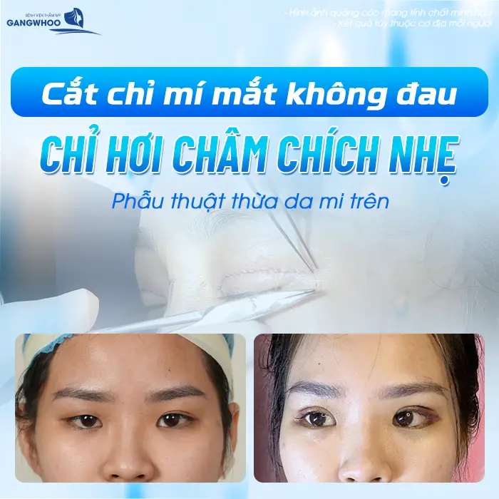 Cắt chỉ mí mắt không đau chỉ hơi châm chích nhẹ 