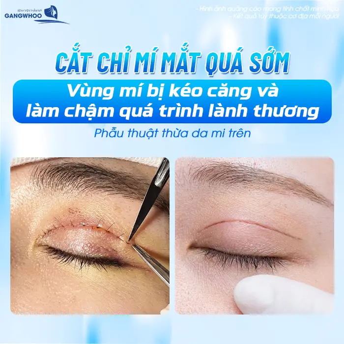 Cắt chỉ mí mắt quá sớm vùng mí bị kéo căng và làm chậm quá trình lành thương 