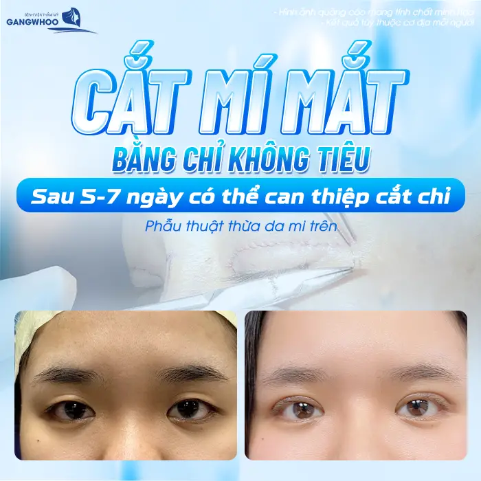 Cắt mí mắt bằng chỉ không tiêu sau 5-7 ngày có thể cab thiệp cắt chỉ