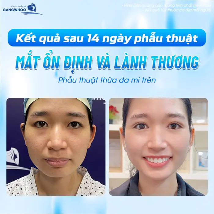 Kết quả sau 14 ngày phẫu thuật mắt ổn định và lành thương