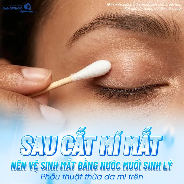 Sau cắt mí mắt nên duy trì việc vệ sinh  mắt bằng nước muối sinh lý