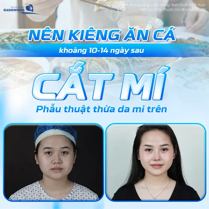 Nên kiêng ăn cá trong khoảng 10-14 ngày sau cắt mí