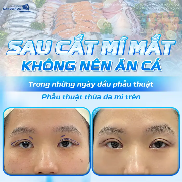 Sau cắt mí mắt không nên ăn cá trong những ngày đầu phẫu thuật 