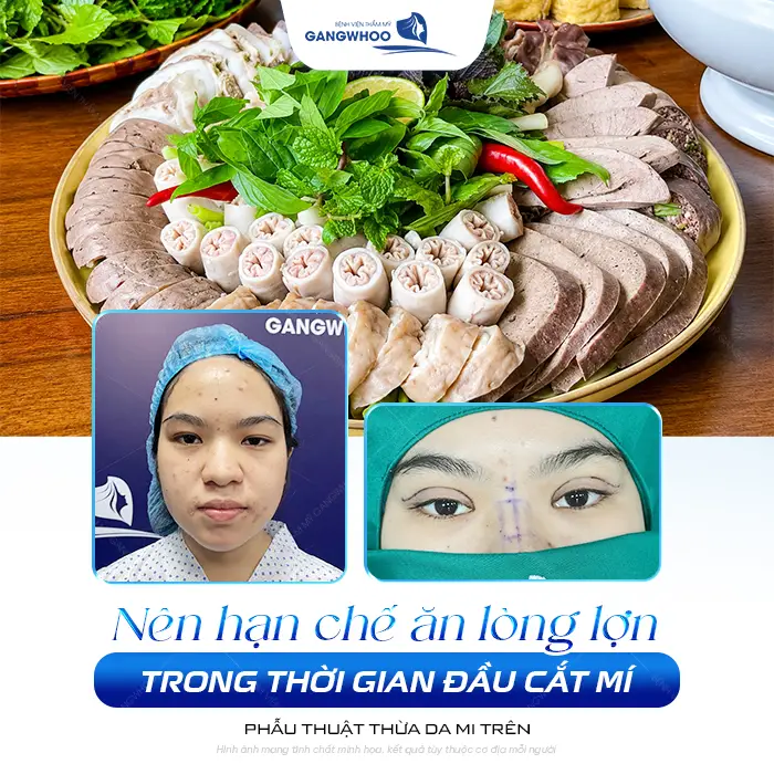 Cắt Mí Mắt Có Ăn Được Lòng Lợn Không? Bác Sĩ Giải Đáp Chi Tiết 1 Cắt Mí Mắt Có Ăn Được Lòng Lợn Không? Bác Sĩ Giải Đáp Chi Tiết